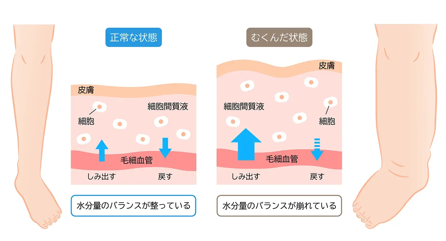 むくんだ状態：水分量のバランスが崩れているとはどんな状態？,整体, 手のしびれ, 猫背矯正, 巻き肩矯正, 冷え, むくみ, 温熱ドーム, みたか西久保整体院, 武蔵野市, 根本改善
