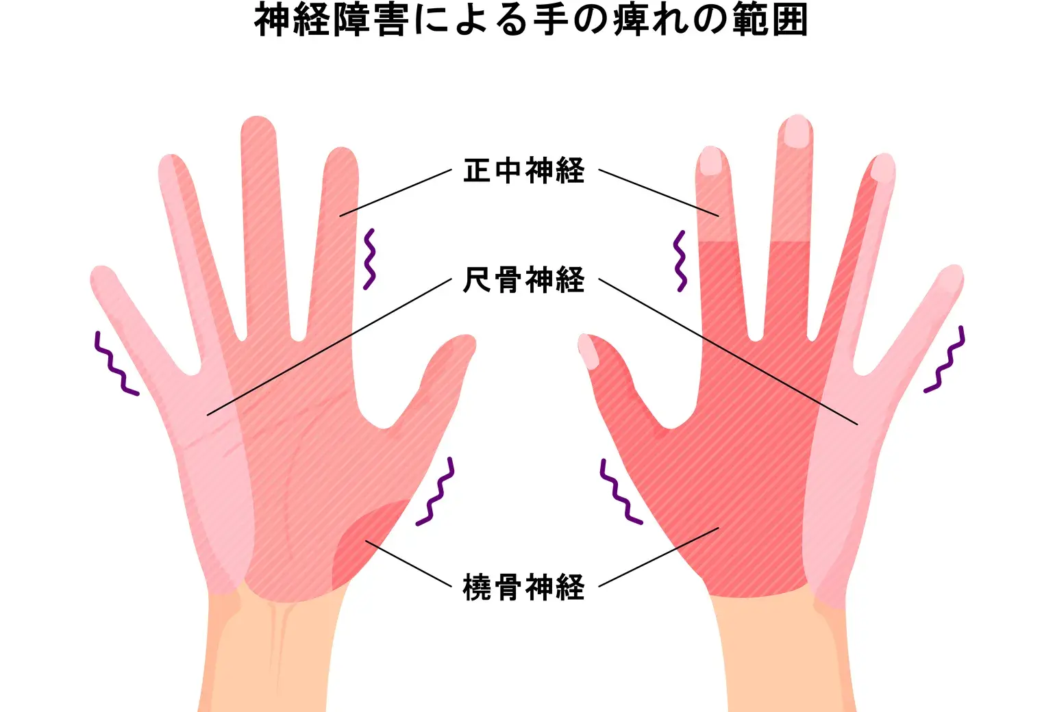 神経障害によるもの, 整体, 手のしびれ, 猫背矯正, 巻き肩矯正, 冷え, むくみ, 温熱ドーム, みたか西久保整体院, 武蔵野市, 根本改善