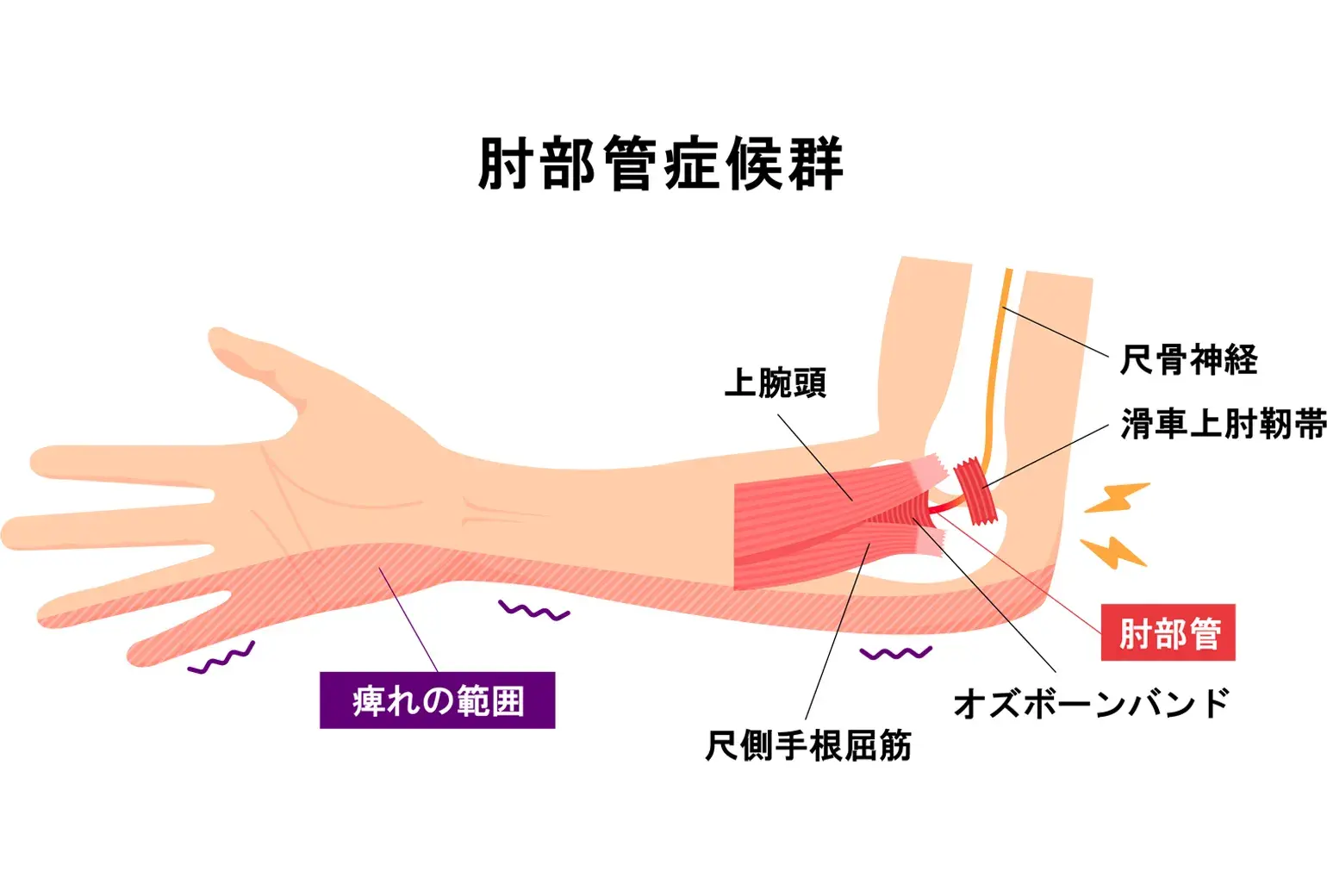 肘部管症候群（ちゅうぶかんしょうこうぐん・尺骨神経の障害）, 整体, 手のしびれ, 猫背矯正, 巻き肩矯正, 冷え, むくみ, 温熱ドーム, みたか西久保整体院, 武蔵野市, 根本改善