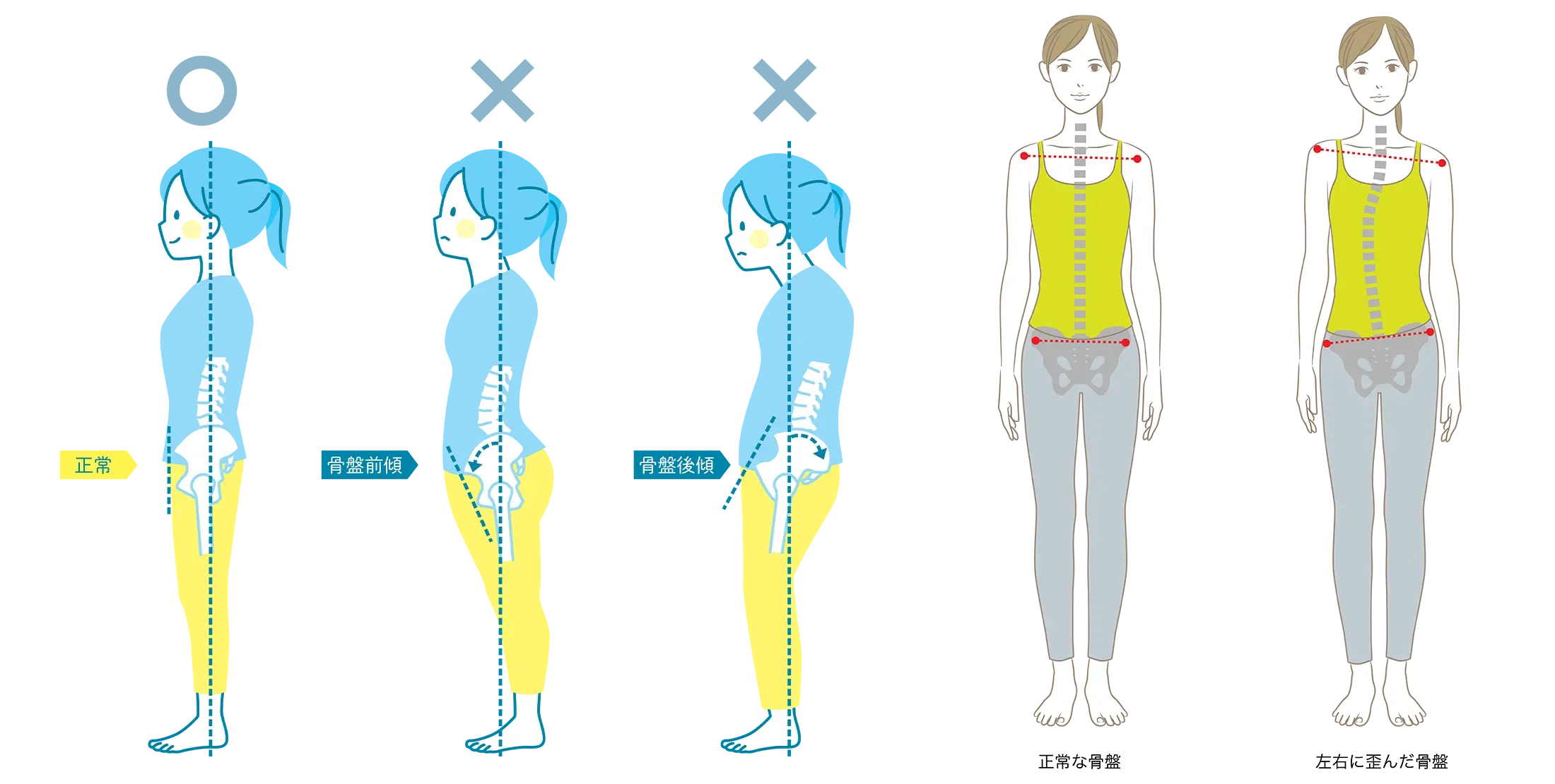 産前産後の腰痛と骨盤の歪みの種類とその特徴,整体, 手のしびれ, 猫背矯正, 巻き肩矯正, 冷え, むくみ, 温熱ドーム, みたか西久保整体院, 武蔵野市, 根本改善
